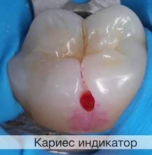 Използване на кариес индикатор за оцветяване на инфектиран зъб в Д-р Радослав Икономов гр. Гоце Делчев